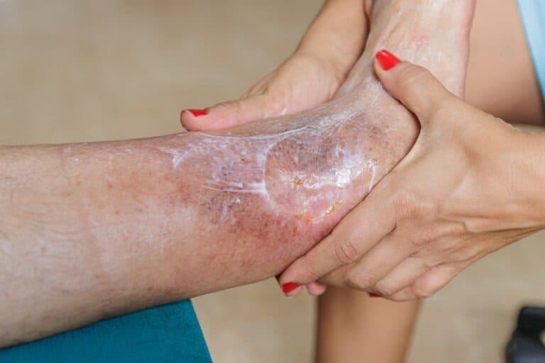 A venous ulcer near the inner ankle, showing typical signs and skin discoloration around the wound.