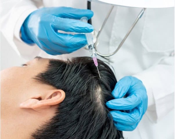 What is a stem cell hair transplant?