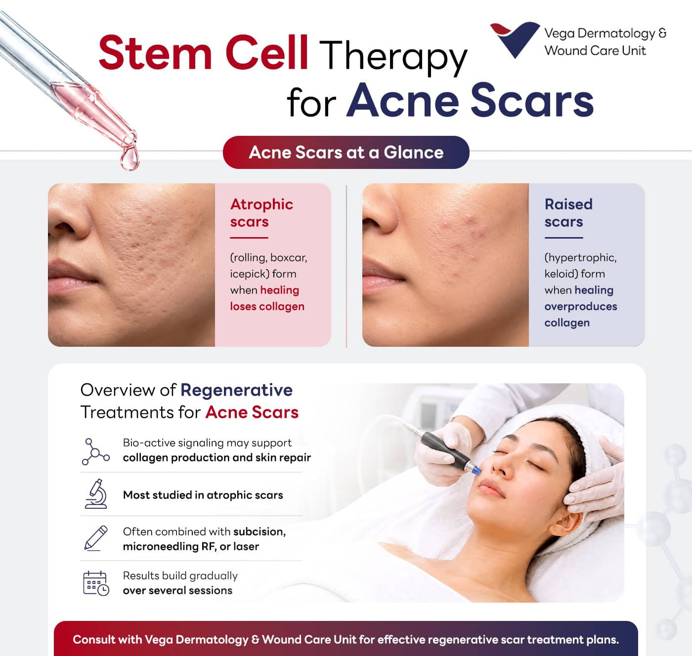Summary table of acne scar treatments, including stem cell therapy. 