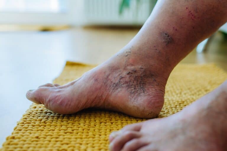 A diabetic foot wound before stem cell treatment for diabetic foot ulcers.