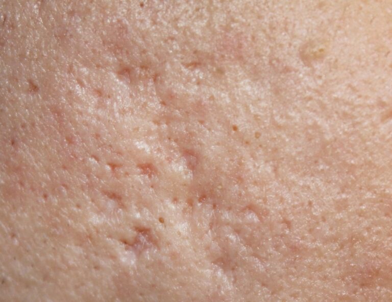 A patient suffering from atrophic scars who is seeking stem cell therapy for acne scars.
