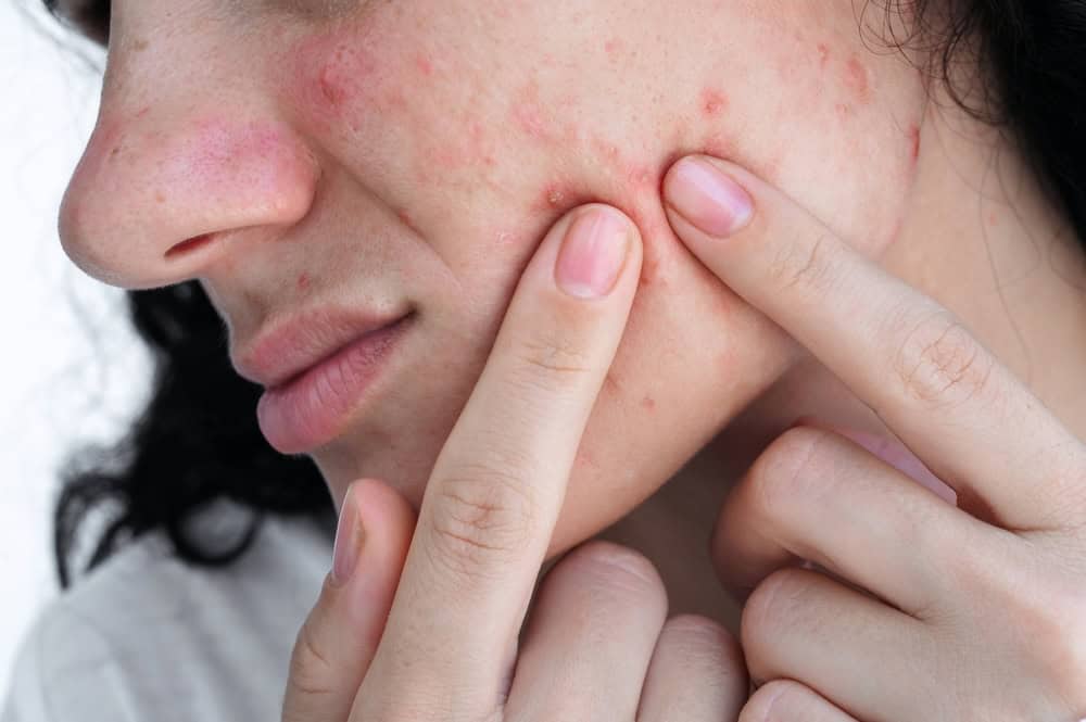 A patient suffering from acne and scars that may benefit from stem cell therapy for acne scars. 