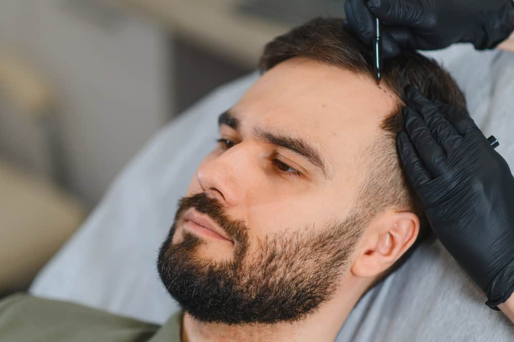 A doctor performs a FUE hair transplantation, a surgical option beyond the regenerative approach.